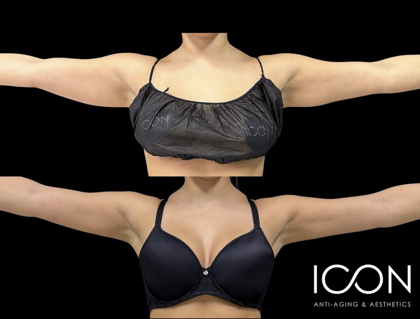 arm lipo5